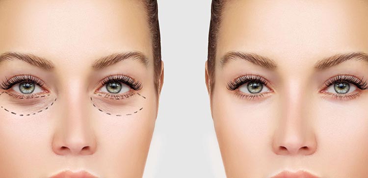 Eyelid Surgery (Blepharoplasty)