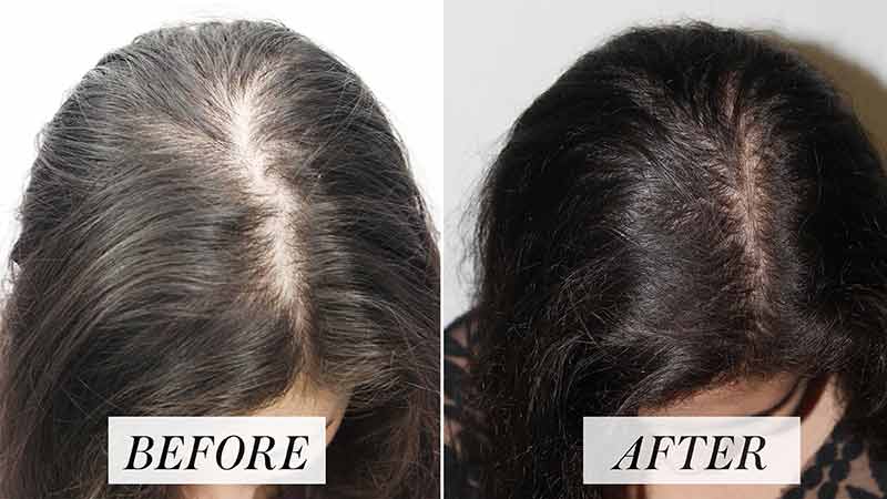 Prp For Hair And Scars - Plastic Surgery NCR